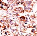 ADCK5 Antibody - Formalin-fixed and paraffin-embedded human cancer tissue reacted with the primary antibody, which was peroxidase-conjugated to the secondary antibody, followed by AEC staining. This data demonstrates the use of this antibody for immunohistochemistry; clinical relevance has not been evaluated. BC = breast carcinoma; HC = hepatocarcinoma.