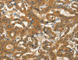 ADCY3 / Adenylate Cyclase 3 Antibody - Immunohistochemistry of paraffin-embedded Human thyroid cancer using ADCY3 Polyclonal Antibody at dilution of 1:50.
