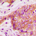 ADD1 / Adducin Alpha Antibody - Immunohistochemical analysis of Alpha-adducin (pT445) staining in human breast cancer formalin fixed paraffin embedded tissue section. The section was pre-treated using heat mediated antigen retrieval with sodium citrate buffer (pH 6.0). The section was then incubated with the antibody at room temperature and detected using an HRP-conjugated compact polymer system. DAB was used as the chromogen. The section was then counterstained with hematoxylin and mounted with DPX.