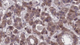 ADGRG3 / GPR97 Antibody - 1:100 staining human liver carcinoma tissues by IHC-P. The sample was formaldehyde fixed and a heat mediated antigen retrieval step in citrate buffer was performed. The sample was then blocked and incubated with the antibody for 1.5 hours at 22°C. An HRP conjugated goat anti-rabbit antibody was used as the secondary.