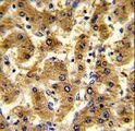 ADH2 / ADH1B Antibody - Formalin-fixed and paraffin-embedded human hepatocarcinoma reacted with ADH1B Antibody , which was peroxidase-conjugated to the secondary antibody, followed by DAB staining. This data demonstrates the use of this antibody for immunohistochemistry; clinical relevance has not been evaluated.