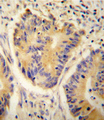 ADH4 Antibody - ADH4 antibody immunohistochemistry of formalin-fixed and paraffin-embedded human colon carcinoma followed by peroxidase-conjugated secondary antibody and DAB staining.