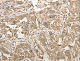 ADHFE1 Antibody - Immunohistochemistry of paraffin-embedded Human esophagus cancer using ADHFE1 Polyclonal Antibody at dilution of 1:50.