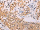 ADHFE1 Antibody - Immunohistochemistry of paraffin-embedded Human lung cancer using ADHFE1 Polyclonal Antibody at dilution of 1:30.