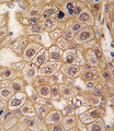 ADRB2 Antibody - Formalin-fixed and paraffin-embedded human hepatocarcinoma tissue reacted with BAR2 Antibody (S261) , which was peroxidase-conjugated to the secondary antibody, followed by DAB staining. This data demonstrates the use of this antibody for immunohistochemistry; clinical relevance has not been evaluated.