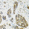 ADSS Antibody - Immunohistochemistry of paraffin-embedded human esophageal cancer using ADSS antibody at dilution of 1:100 (40x lens).