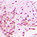 AFF1 / AF4 Antibody - Immunohistochemical analysis of AF4 staining in human breast cancer formalin fixed paraffin embedded tissue section. The section was pre-treated using heat mediated antigen retrieval with sodium citrate buffer (pH 6.0). The section was then incubated with the antibody at room temperature and detected using an HRP conjugated compact polymer system. DAB was used as the chromogen. The section was then counterstained with hematoxylin and mounted with DPX.
