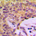 AGBL2 / CCP2 Antibody - Immunohistochemical analysis of CCP2 staining in human breast cancer formalin fixed paraffin embedded tissue section. The section was pre-treated using heat mediated antigen retrieval with sodium citrate buffer (pH 6.0). The section was then incubated with the antibody at room temperature and detected using an HRP conjugated compact polymer system. DAB was used as the chromogen. The section was then counterstained with hematoxylin and mounted with DPX.