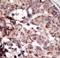 AGER / RAGE Antibody - Formalin-fixed and paraffin-embedded human cancer tissue reacted with the primary antibody, which was peroxidase-conjugated to the secondary antibody, followed by AEC staining. This data demonstrates the use of this antibody for immunohistochemistry; clinical relevance has not been evaluated. BC = breast carcinoma; HC = hepatocarcinoma.