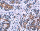 AGFG1 Antibody - Immunohistochemistry of paraffin-embedded Human colon cancer using AGFG1 Polyclonal Antibody at dilution of 1:50.