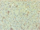 AGO2 / EIF2C2 Antibody - Immunohistochemistry of paraffin-embedded human breast cancer using antibody at 1:100 dilution.  This image was taken for the unconjugated form of this product. Other forms have not been tested.