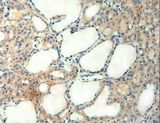 AGRN / Agrin Antibody - Immunohistochemistry of paraffin-embedded Human thyroid cancer using AGRN Polyclonal Antibody at dilution of 1:50.