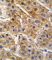 AGT / Angiotensinogen Antibody - Formalin-fixed and paraffin-embedded human hepatocarcinoma tissue reacted with AGT antibody , which was peroxidase-conjugated to the secondary antibody, followed by DAB staining. This data demonstrates the use of this antibody for immunohistochemistry; clinical relevance has not been evaluated.