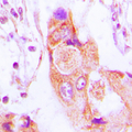 AIM2 Antibody - Immunohistochemical analysis of AIM2 staining in human lung cancer formalin fixed paraffin embedded tissue section. The section was pre-treated using heat mediated antigen retrieval with sodium citrate buffer (pH 6.0). The section was then incubated with the antibody at room temperature and detected using an HRP conjugated compact polymer system. DAB was used as the chromogen. The section was then counterstained with hematoxylin and mounted with DPX.