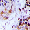 AK6 / Adenylate Kinase 6 Antibody - Immunohistochemical analysis of Adenylate Kinase 6 staining in human prostate cancer formalin fixed paraffin embedded tissue section. The section was pre-treated using heat mediated antigen retrieval with sodium citrate buffer (pH 6.0). The section was then incubated with the antibody at room temperature and detected with HRP and DAB as chromogen. The section was then counterstained with hematoxylin and mounted with DPX.