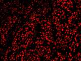AKAP8L Antibody - Detection of human AKAP8L/HA95 by immunohistochemistry. Sample: FFPE section of human breast carcinoma. Antibody: Affinity purified rabbit anti-AKAP8L/HA95 used at a dilution of 1:100. Detection: Red-fluorescent goat anti-rabbit IgG highly cross-adsorbed IHC Antibody Hilyte Plus™ 555 used at a dilution of 1:100.