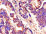 AKAP9 / YOTIAO Antibody - Immunohistochemistry of paraffin-embedded human colon cancer using AKAP9 Antibody at dilution of 1:100