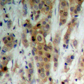 AKT1 + AKT2 + AKT3 Antibody - Immunohistochemical analysis of AKT (pS246) staining in human breast cancer formalin fixed paraffin embedded tissue section. The section was pre-treated using heat mediated antigen retrieval with sodium citrate buffer (pH 6.0). The section was then incubated with the antibody at room temperature and detected using an HRP conjugated compact polymer system. DAB was used as the chromogen. The section was then counterstained with hematoxylin and mounted with DPX.