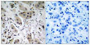 AKT1 + AKT2 + AKT3 Antibody - Immunohistochemistry analysis of paraffin-embedded human breast carcinoma, using Akt (Phospho-Ser473) Antibody. The picture on the right is blocked with the phospho peptide.