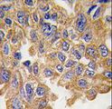 AKT2 Antibody - Formalin-fixed and paraffin-embedded human lung carcinoma tissue reacted with AKT2 Antibody (S474), which was peroxidase-conjugated to the secondary antibody, followed by DAB staining. This data demonstrates the use of this antibody for immunohistochemistry; clinical relevance has not been evaluated.