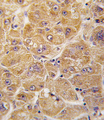 ALDH1A1 / ALDH1 Antibody - Formalin-fixed and paraffin-embedded human hepatocarcinoma tissue reacted with ALDH1A1 antibody , which was peroxidase-conjugated to the secondary antibody, followed by DAB staining. This data demonstrates the use of this antibody for immunohistochemistry; clinical relevance has not been evaluated.