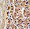 ALDH1A1 / ALDH1 Antibody - ALDH1A1 Antibody IHC of formalin-fixed and paraffin-embedded human hepatocarcinoma followed by peroxidase-conjugated secondary antibody and DAB staining.