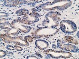 ALDH1A3 Antibody - IHC of paraffin-embedded Carcinoma of Human prostate tissue using anti-ALDH1A3 mouse monoclonal antibody. (Heat-induced epitope retrieval by 10mM citric buffer, pH6.0, 120°C for 3min).