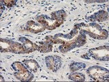 ALDH1A3 Antibody - IHC of paraffin-embedded Carcinoma of Human prostate tissue using anti-ALDH1A3 mouse monoclonal antibody.