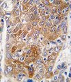 ALDH1L1 Antibody - Formalin-fixed and paraffin-embedded human hepatocarcinoma tissue reacted with ALDH1L1 antibody , which was peroxidase-conjugated to the secondary antibody, followed by DAB staining. This data demonstrates the use of this antibody for immunohistochemistry; clinical relevance has not been evaluated.