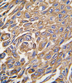 ALDH3A1 Antibody - Formalin-fixed and paraffin-embedded human lung carcinoma tissue reacted with ALDH3A1 antibody , which was peroxidase-conjugated to the secondary antibody, followed by DAB staining. This data demonstrates the use of this antibody for immunohistochemistry; clinical relevance has not been evaluated.