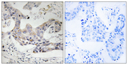 ALDH3B1 Antibody - Immunohistochemistry analysis of paraffin-embedded human breast carcinoma tissue, using ALDH3B1 Antibody. The picture on the right is blocked with the synthesized peptide.