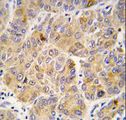 ALDH9A1 Antibody - Formalin-fixed and paraffin-embedded human hepatocarcinoma tissue reacted with ALDH9A1 antibody , which was peroxidase-conjugated to the secondary antibody, followed by DAB staining. This data demonstrates the use of this antibody for immunohistochemistry; clinical relevance has not been evaluated.