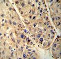 ALDP / ABCD1 Antibody - ABCD1 antibody immunohistochemistry of formalin-fixed and paraffin-embedded human hepatocarcinoma followed by peroxidase-conjugated secondary antibody and DAB staining.