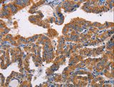 ALG9 Antibody - Immunohistochemistry of paraffin-embedded Human thyroid cancer using ALG9 Polyclonal Antibody at dilution of 1:30.