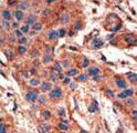 ALK3 / BMPR1A Antibody - Formalin-fixed and paraffin-embedded human cancer tissue reacted with the primary antibody, which was peroxidase-conjugated to the secondary antibody, followed by AEC staining. This data demonstrates the use of this antibody for immunohistochemistry; clinical relevance has not been evaluated. BC = breast carcinoma; HC = hepatocarcinoma.