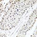ALKBH4 Antibody - Immunohistochemistry of paraffin-embedded human lung cancer tissue.