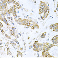 ALKBH8 Antibody - Immunohistochemistry of paraffin-embedded human gastric cancer tissue.