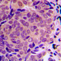 ALMS1 Antibody - Immunohistochemical analysis of ALMS1 staining in human breast cancer formalin fixed paraffin embedded tissue section. The section was pre-treated using heat mediated antigen retrieval with sodium citrate buffer (pH 6.0). The section was then incubated with the antibody at room temperature and detected using an HRP conjugated compact polymer system. DAB was used as the chromogen. The section was then counterstained with hematoxylin and mounted with DPX.