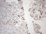 ALOX12 / 12 Lipoxygenase Antibody - Immunohistochemical staining of paraffin-embedded Carcinoma of Human thyroid tissue using anti-ALOX12 mouse monoclonal antibody. (Heat-induced epitope retrieval by 1mM EDTA in 10mM Tris buffer. (pH8.5) at 120°C for 3 min. (1:150)