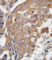 ALOX5AP / FLAP Antibody - Formalin-fixed and paraffin-embedded human lung carcinoma tissue reacted with ALOX5AP antibody , which was peroxidase-conjugated to the secondary antibody, followed by DAB staining. This data demonstrates the use of this antibody for immunohistochemistry; clinical relevance has not been evaluated.
