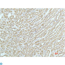 Alpha Actinin Antibody - Immunohistochemistry (IHC) analysis of paraffin-embedded Human Breast Carcinoma Tissue using a-actinin Mouse Monoclonal Antibody diluted at 1:200.