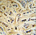 Alpha-S1-Casein / CSN1S1 Antibody - CASA Antibody (RB18742) IHC of formalin-fixed and paraffin-embedded human breast carcinoma tissue followed by peroxidase-conjugated secondary antibody and DAB staining.