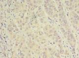 Alpha SNAP Antibody - Immunohistochemistry of paraffin-embedded human liver cancer using antibody at dilution of 1:100.