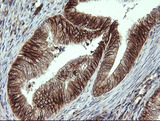ALX4 Antibody - IHC of paraffin-embedded Adenocarcinoma of Human endometrium tissue using anti-ALX4 mouse monoclonal antibody.
