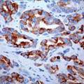 AMACR / P504S Antibody - Formalin-fixed, paraffin-embedded human prostate cancer stained with DAB chromogen. Note cytoplasmic staining of tumor cells.