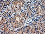 AMY2A / Pancreatic Amylase Antibody - IHC of paraffin-embedded Adenocarcinoma of ovary using anti-AMY2A mouse monoclonal antibody.