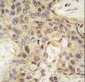ANGEL2 Antibody - Formalin-fixed and paraffin-embedded human breast carcinoma tissue reacted with ANGEL2 antibody , which was peroxidase-conjugated to the secondary antibody, followed by DAB staining. This data demonstrates the use of this antibody for immunohistochemistry; clinical relevance has not been evaluated.