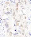 Anillin Antibody - Detection of Human Anillin by Immunohistochemistry. Sample: FFPE section of human colon carcinoma. Antibody: Affinity purified rabbit anti-Anillin used at a dilution of 1:1000 (1 ug/ml).