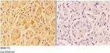 ANKRD20A3 Antibody - Immunohistochemistry (IHC) analysis of ANKRD20A3 antibody in paraffin-embedded human stomach carcinoma tissue at 1:50, showing membrane and cytoplasmic staining. Negative control (the right) using PBS instead of primary antibody. Secondary antibody is Goat Anti-R.