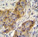 ANKRD39 Antibody - ANR39 Antibody immunohistochemistry of formalin-fixed and paraffin-embedded human breast carcinoma followed by peroxidase-conjugated secondary antibody and DAB staining.